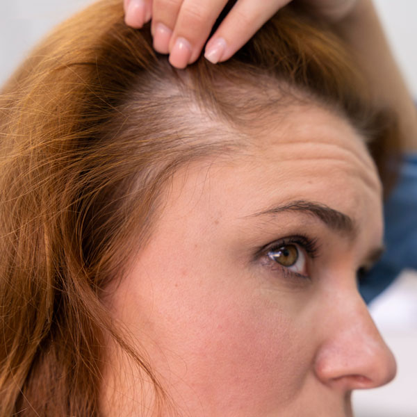 Aromaterapi ile Saç Dökülmesine Destek